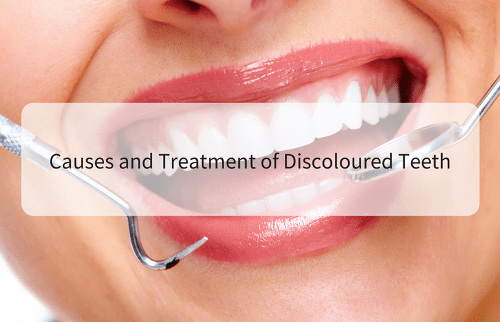 Causes and Treatment of Discoloured Teeth
